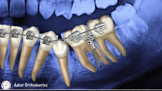 Orthodontic Case presentation-braces-brackets-impacted teeth-uprighting. Ортодонтия.