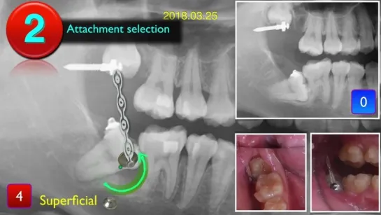 Innovative Impaction Treatment  2018 Part 5. Ортодонтия.