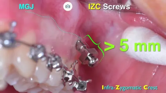 2018 AAO Innovative Impaction Treatment Part 1（live）Ортодонтия.