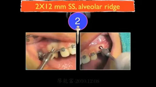 CBCT  Impacted cuspids-1  Ортодонтия.