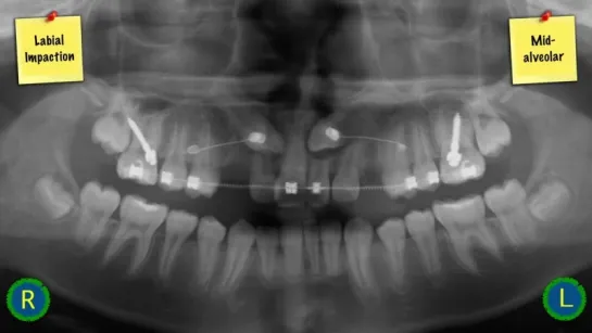 Innovative Impaction Treatment  2018 Part 2. Ортодонтия.