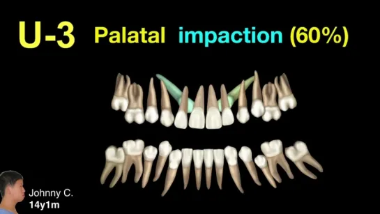 Innovative Impaction Treatment  2018 Part 1. Ортодонтия.