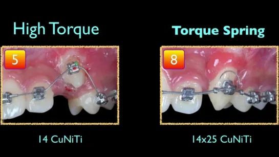 Innovative Impaction Treatment  2018 Part 3. Ортодонтия.