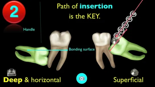 Screw Invisalign Part 3. Ортодонтия.