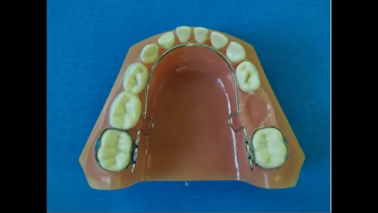 Ортодонтические аппараты. Язычная дуга.
