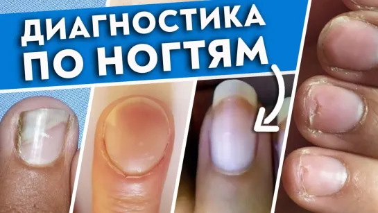 Как определить болезнь по ногтям?  Ногти скажут всё о вашем здоровье!