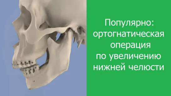 Популярно: ортогнатическая операция по увеличению нижней челюсти. Стоматология