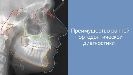 Почему лучше провести диагностику и составить план лечения на брекетах как можно раньше?