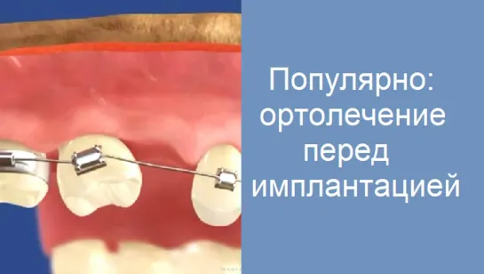 Популярно: ортодонтическая подготовка к имплантации и протезированию. Брекеты. Стоматология.