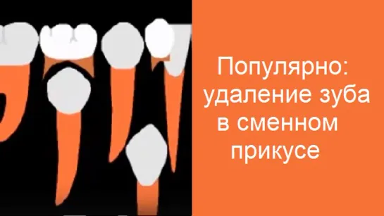 Популярно: движение зубов в сменном прикусе. Вариант с нехваткой места и удалением. Ортодонтия.