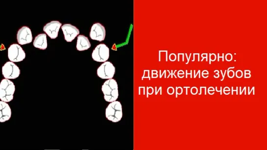 Популярно: движение зубов при ортолечении. Ортодонтия.