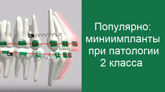 Популярно: использование миниимлантов и брекетов при патологии 2 класса. Ортодонтия. Стоматология