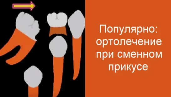 Популярно: ортодонтическое лечение при смещении зубов после раннего удаления зуба. Стоматология