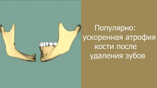 Популярно: ускоренная атрофия костной ткани после удаления зубов. Стоматология.