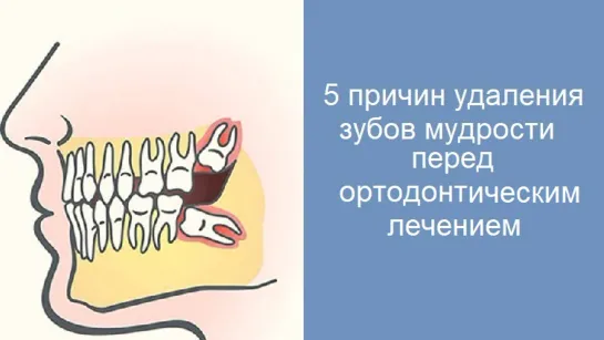 Пять причин для удаления зубов мудрости перед ортодонтическим лечением.