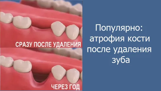 Популярно об атрофии кости после удаления зуба. Стоматология.