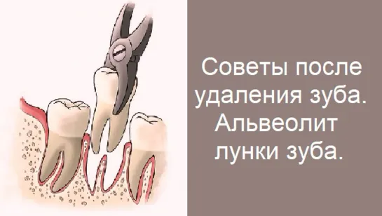 Рекомендации после Удаления Зуба. Альвеолит - воспаление лунки удаленного зуба. Стоматология