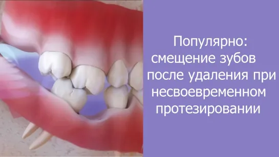 Популярно: смещение зубов после удаления при несвоевременном протезировании. Стоматология.