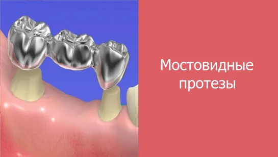 Мостовидные протезы: показания, плюсы и минусы.Стоматология