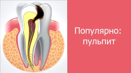 Пульпит. Популярно о "воспалении нерва" Стоматология