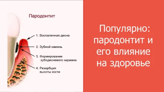 Популярно: пародонтит и его влияние на состояние здоровье. Стоматология. Пародонтология