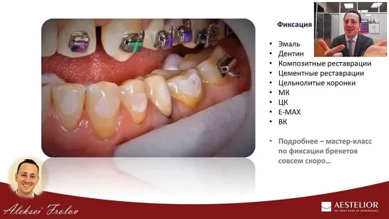 Вебинар Фролова А. О.Carriere SLX 3D - революционные самолигирующие брекеты.