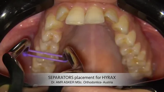 Установка "сепараторов" перед фиксацией аппарата HYRAX. Dr. Amr Asker. Ортодонтия.