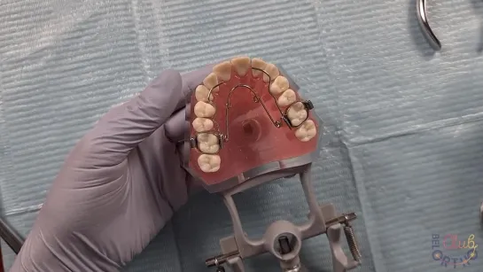 Коррекция формы верхнего зубного ряда пружиной Квадхеликс. Ортодонтия.