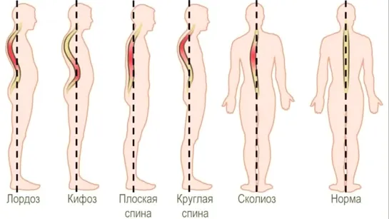 Как тренироваться при сколиозе?