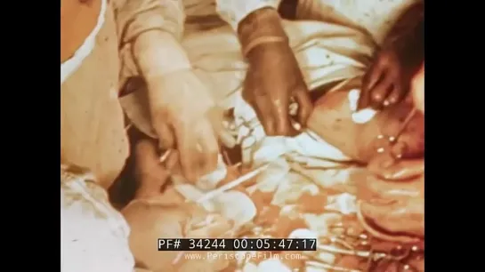 KOREAN WAR U.S. NAVY SURGERY FILM DOUBLE AMPUTATION OF LEGS 34244