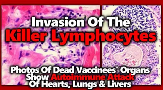 Drs Sucharit Bhakdi & Michael Palmer: Vaccinee Autopsies – Killer Lymphocytes Invade Vital Organs