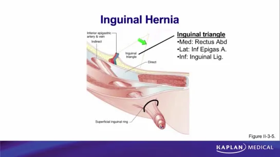 25. Anatomy - Sec II Abdomen, Pelvis, and Perineum - Inguinal Hernia