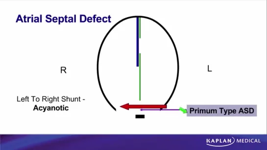 17. Anatomy - Sec II Thorax - Atrial Septal Defect