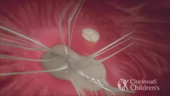 Atrioventricular Septal Defect - AV Canal