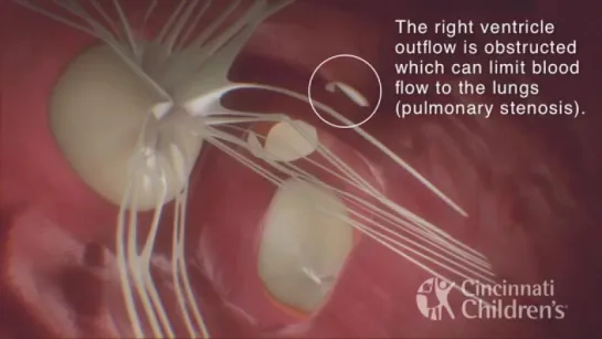 Tetralogy of Fallot