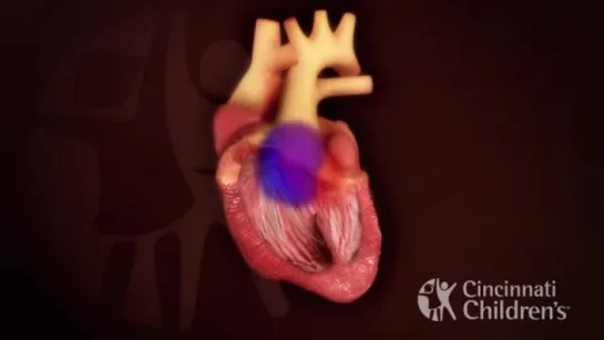 Truncus Arteriosus