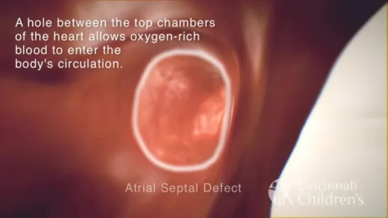 Total Anomalous Pulmonary Venous Return