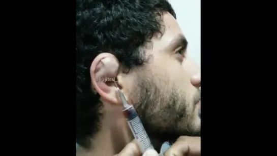 Death of a monster cauliflower ear. It feels good when you empty it...