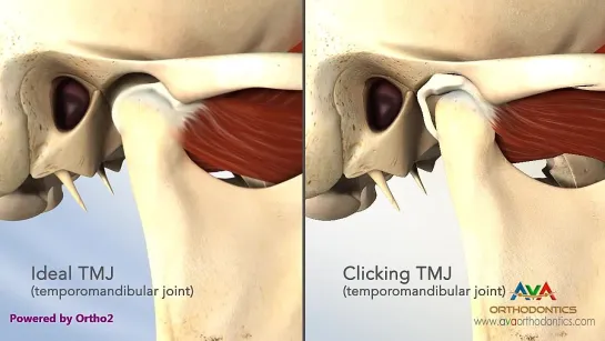 TMJ Disorder or TMD - Clicking and Closed Lock