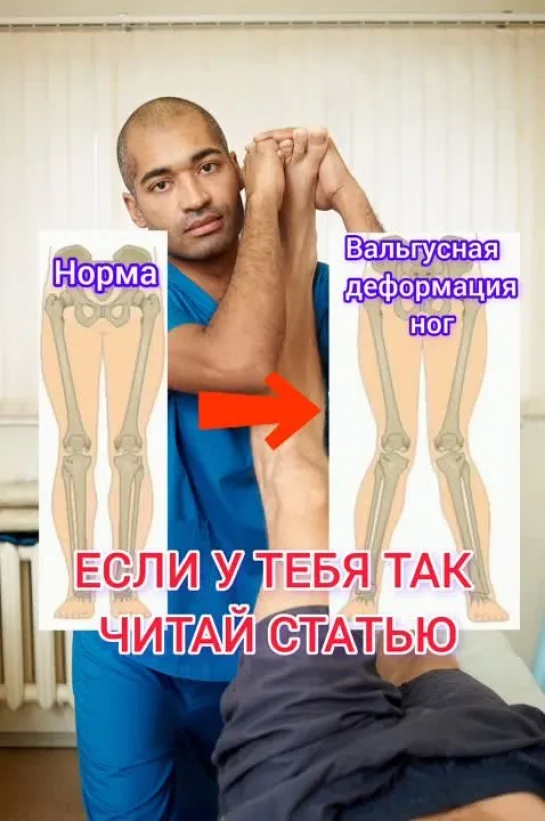 ВАЛЬГУСНАЯ ДЕФОРМАЦИЯ НОГ