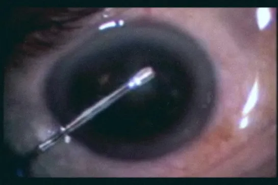 Botched Eyeball Operation (2007) by Clint Enns and Denys Gareau