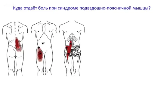 Симптомы поражения подвздошно-поясничной мышцы