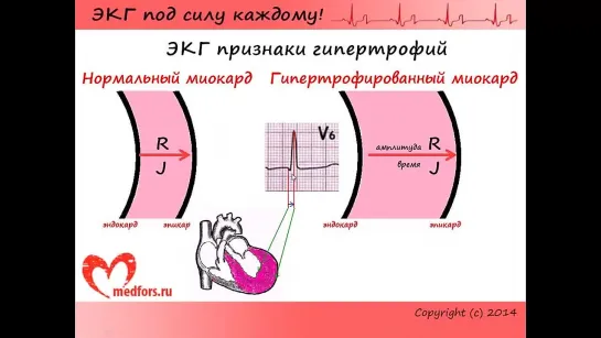 Урок 8. Видеокурс ЭКГ под силу каждому