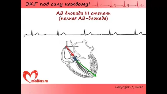 Урок 6. Видеокурс ЭКГ под силу каждому