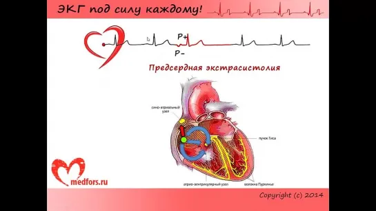 Урок 4. Видеокурс ЭКГ под силу каждому