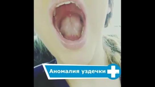 Аномалия lingual frenulum