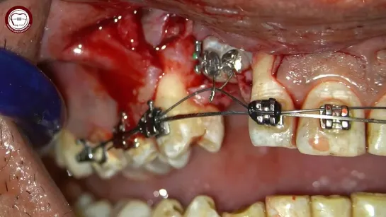 Corticotomy  of impacted canine in orthodontics