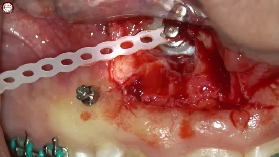 Orthodontic Distal traction of impacted canine on mini screw TAD