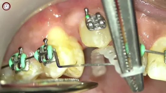 Single power chain vertical canine  traction in orthodontics