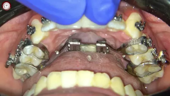 Banded HYRAX expander removal in orthodontics